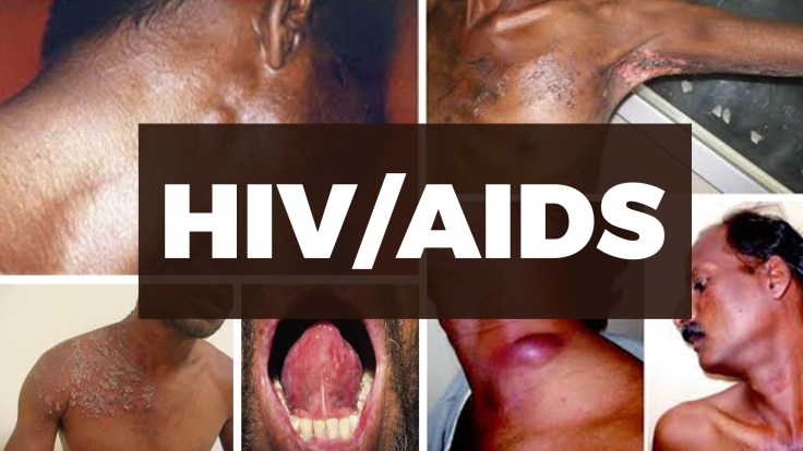 HIV/AIDS